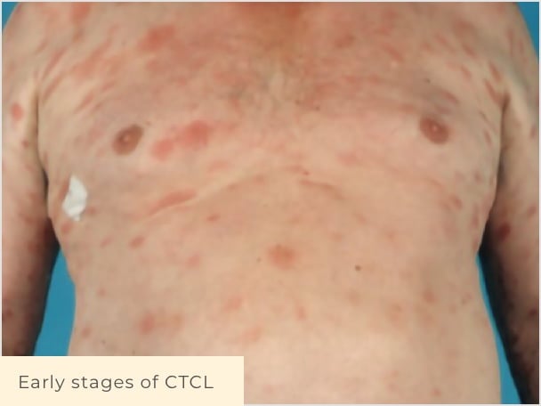 Patient with early stage CTCL