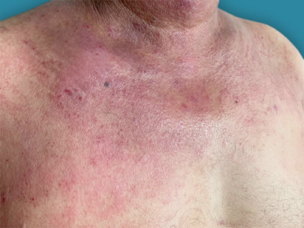 CTCL or Eczema slider