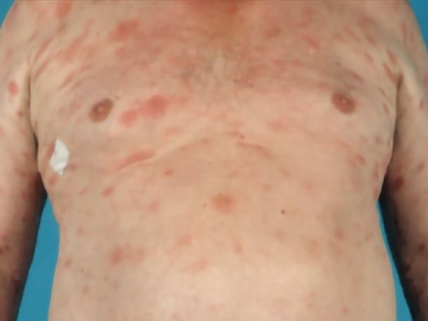 CTCL or Eczema slider