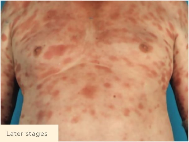 Patient with later stage CTCL