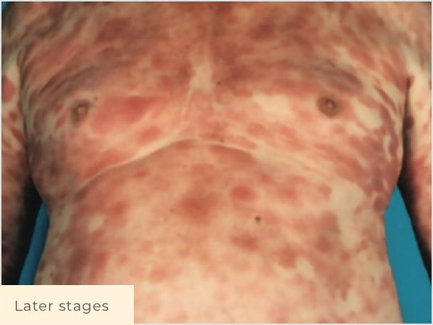 Patient with later stage CTCL