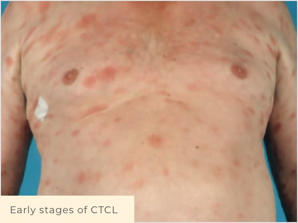 Patient with early stage CTCL