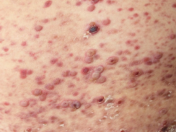 CTCL or Pityriasis lichenoides  slider