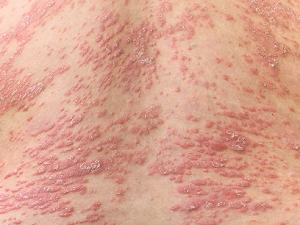 CTCL or Psoriasis slider